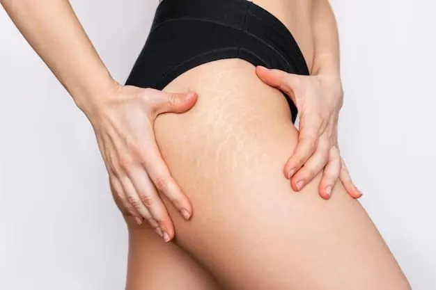 Top 10 Melhores Cremes para Estrias ATUALIZADO